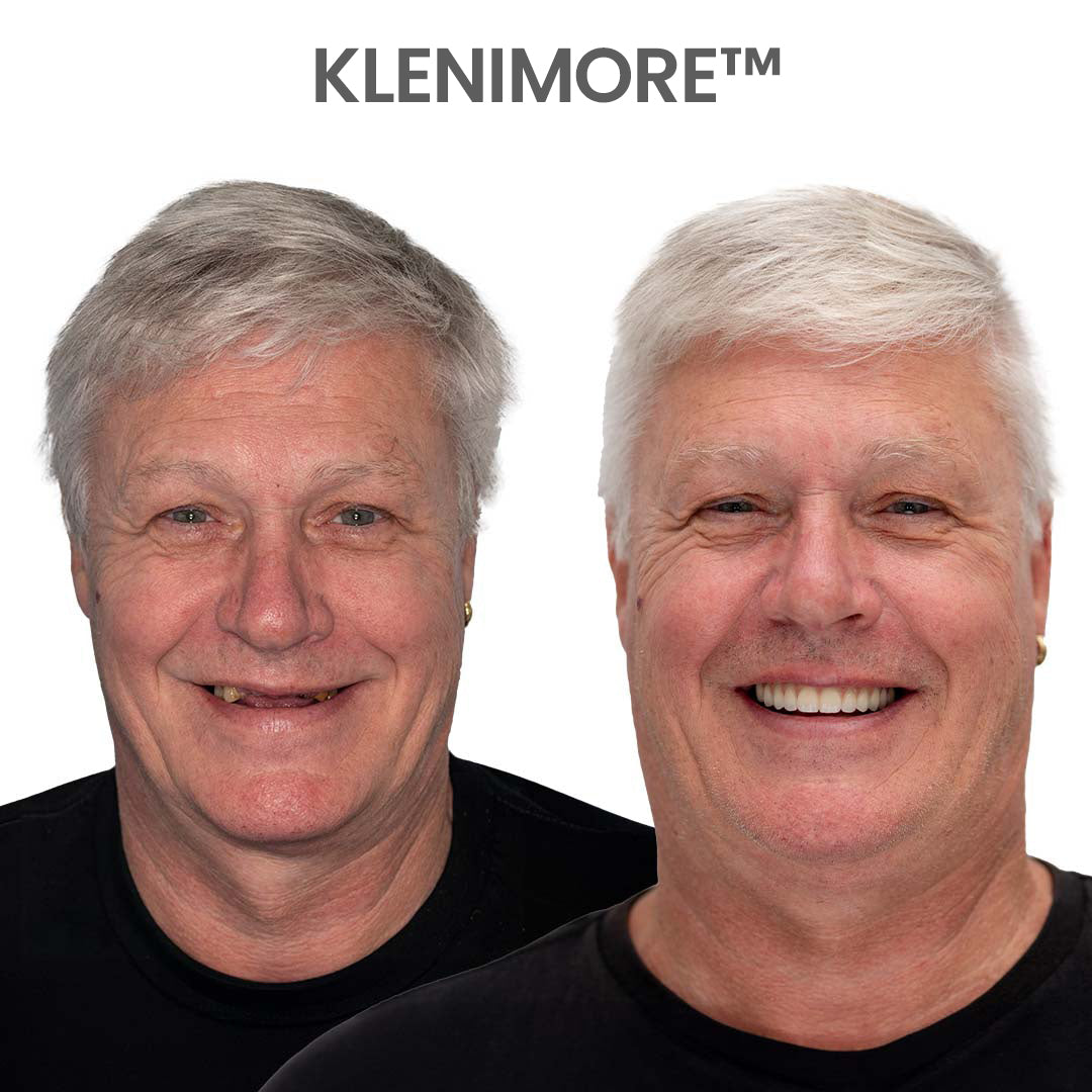 ⏰ KLENIMORE™ Custom-Fit Dentures  ENDS TODAY   70% OFF | Smile with Confidence