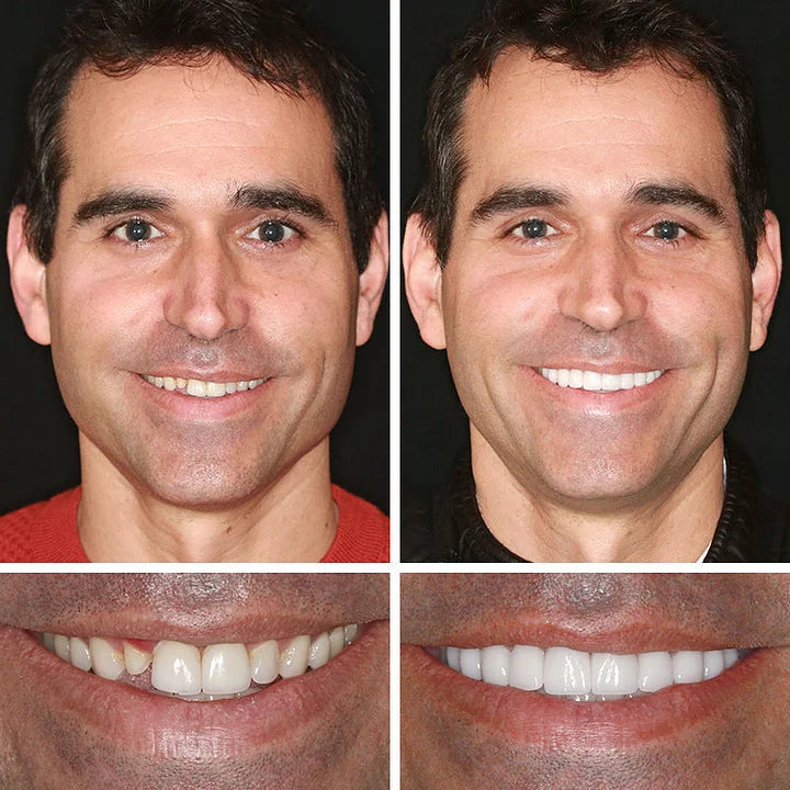 ⏰ Aurora Tech™ Custom-Fit Dentures  ENDS TODAY   70% OFF | Smile with Confidence