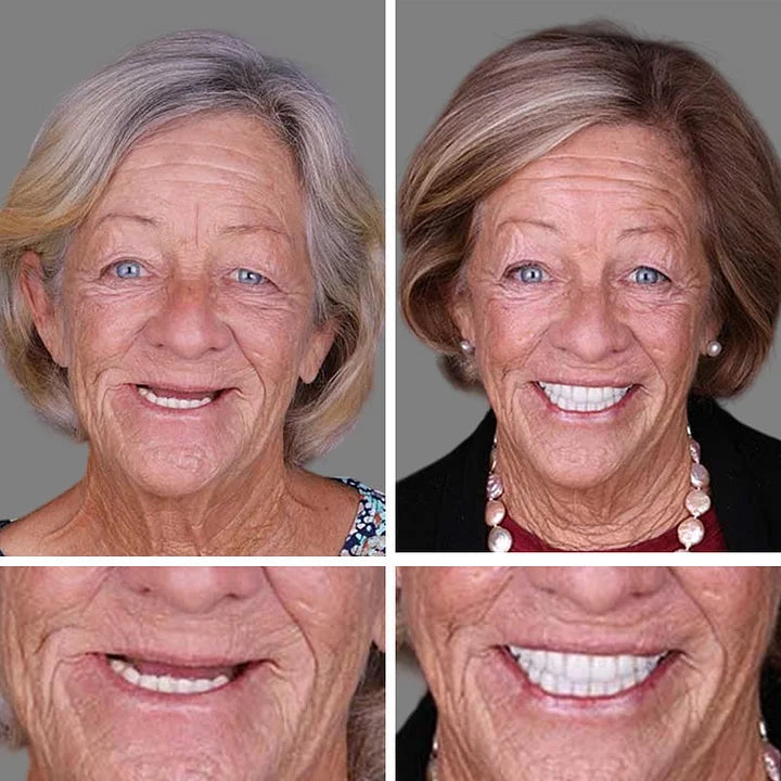 ⏰ Aurora Tech™ Custom-Fit Dentures  ENDS TODAY   70% OFF | Smile with Confidence