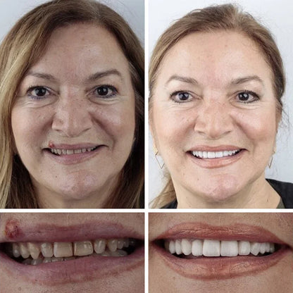 ⏰ Aurora Tech™ Custom-Fit Dentures  ENDS TODAY   70% OFF | Smile with Confidence