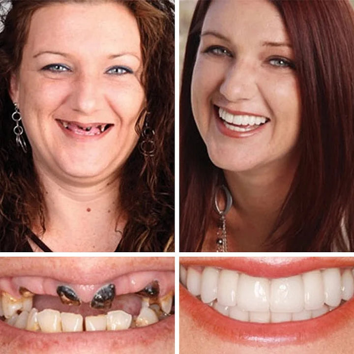 ⏰ Aurora Tech™ Custom-Fit Dentures  ENDS TODAY   70% OFF | Smile with Confidence