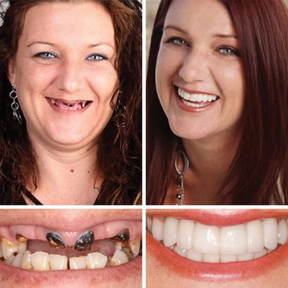 ⏰ Aurora Tech™ Custom-Fit Dentures  ENDS TODAY   70% OFF | Smile with Confidence